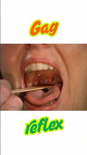 Gag reflex | Clinical testing of glossopharyngeal nerve | Gag reflex test #shortsindia