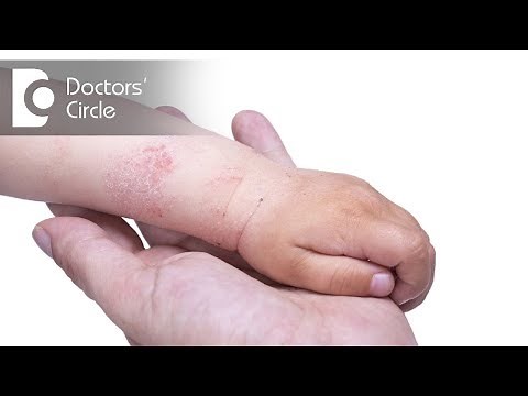 How to manage Atopic Dermatitis in children? - Dr. Divya Sharma