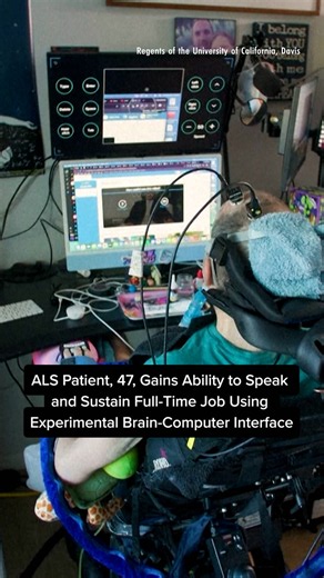 ALS patient, 47, gains ability to speak and sustain full-time job using experimental brain-computer interface