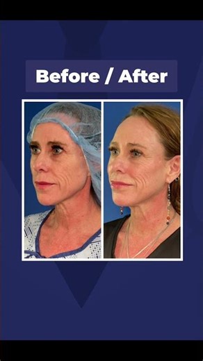 PDO Threads: The Secret to Tight Skin Without Surgery! #shorts