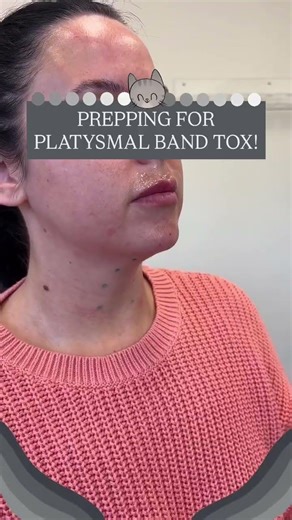 Prepping for Platysmal Band Tox!