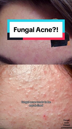 Understanding Fungal Acne vs. Closed Comedones: Dermatologist Tips