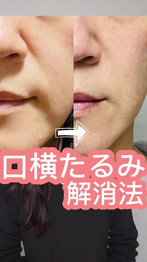 口周りのたるみ解消法｜マリオネットライン消す方法