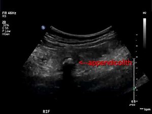 appendicele