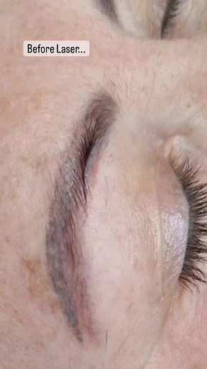 This client had a multi coloured eyebrow tattoo that was completely out of her natural brow shape and asymmetrical. We had to do 3 laser tattoo removal sessions over the past 2 years to get to the point where the old colour was light enough to do hairstrokes over it. Laser and correction work can be a long process, but so worth it when you can finally get the brows you deserve. . To book or get more info email hello@powderpuffmakeup.co.za/ 27 84 322 9765 . . @monicaivani.mybrows absolute brown @