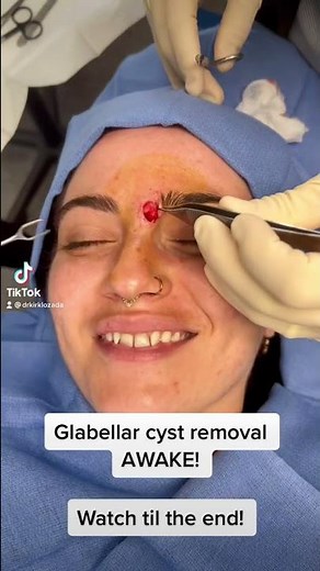 Forehead cyst removal AWAKE in the office