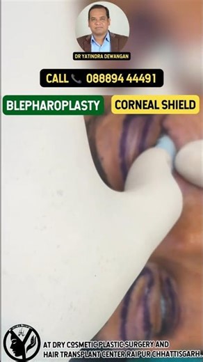 Safe Blepharoplasty 👁️ | Corneal Shield Protection Explained 🔒 #Shorts