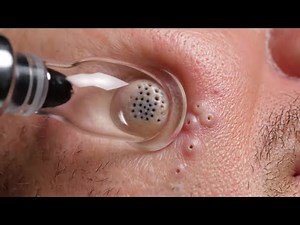 Blackhead Extraction with Bright Lighting | High Clarity Results