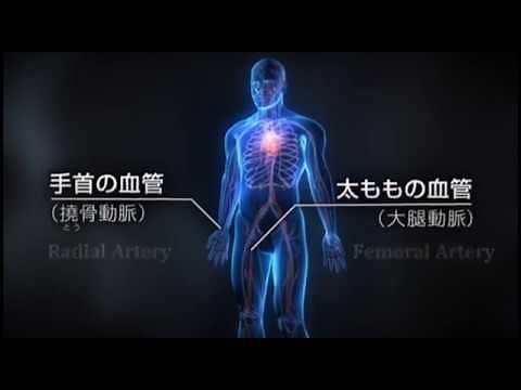 Terumo -「カテーテル治療の手順イメージ」