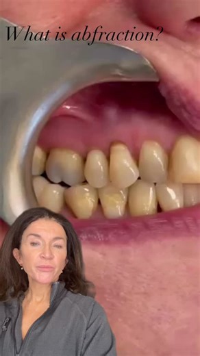 Tracey Bell Dental~Aesthetic Medical Clinics on Instagram: "What is abfraction — and why does it matter? Abfraction is a common but often misunderstood cause of tooth sensitivity. It appears as a sharp notch at the gum margin and is not decay. 🔹 It is caused by excessive biting forces 🔹 Teeth flex microscopically under load 🔹 Micro-cracks form in enamel 🔹 Enamel fractures away 🔹 Dentine becomes exposed → sensitivity In this clinical case, the teeth will be restored because the dentine is ex
