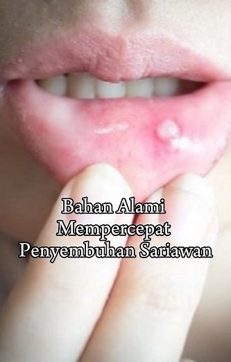 Tips Menyembuhkan Sariawan dengan cepat #obat #alami #sariawan