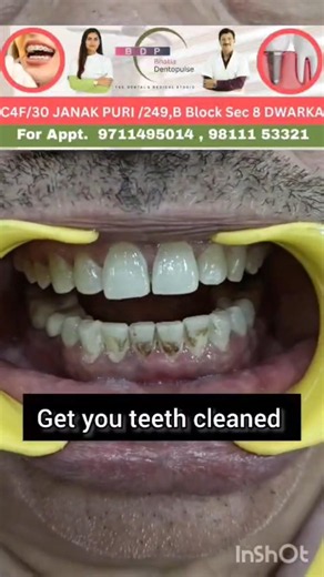 Black stains on your teeth? Watch this! #teethcleaning #teeth