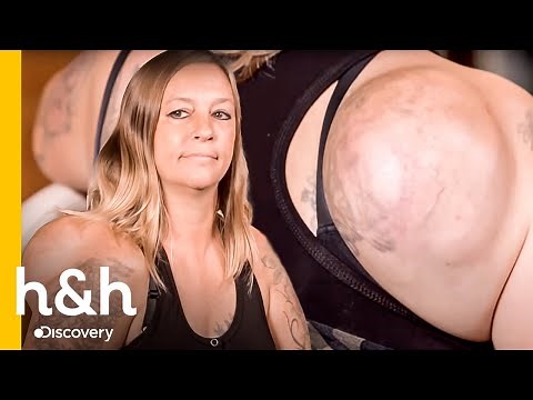 Dra. Lee extrae lipoma de 2.8 KG | Dra. Sandra Lee: Especialista en piel | Discovery H&H