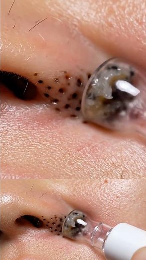 Blackhead Cluster Clearing — Nose Fold ASMR