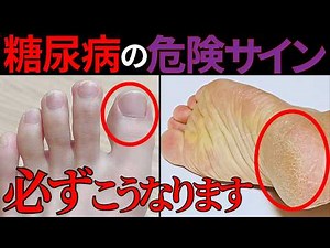 【医師監修】絶対に見逃してはいけない「糖尿病で起きやすい足の危険サイン」症状から予防法まで徹底的に解説します