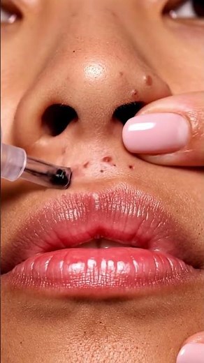 Deep Blackhead Removal That's Actually Insane #extraction #satisfying #skincare