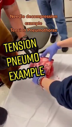 Needle Decompression example #trauma #ShadowAndBone #nursing #fyp #teaching #foryou #paramedic #med #ems