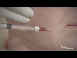 Restylane Skinbooster - Signature technique injection animation