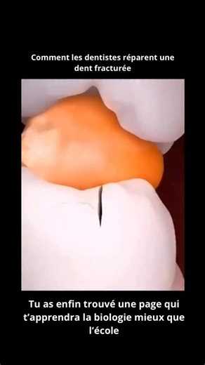 Biologie.Explicative | Une dent fracturée est bien plus qu’une simple fissure visible : c’est un problème dentaire sérieux qui peut affecter les couches internes... | Instagram