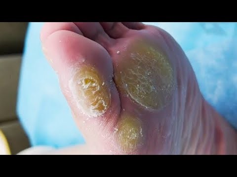 Large and Hard callus on the sole of foot【Joo Yidao】