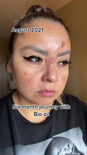 Bio Oil Skincare for Shingles Scars: Before and After Journey