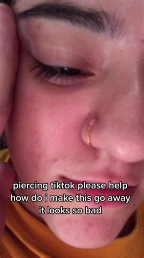 Effective Ways to Treat Nose Piercing Keloids and Bumps