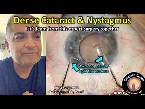 CataractCoach 1091: dense cataract with nystagmus - ocular albinism