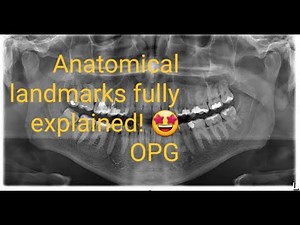 OPG Detailed Explanation Of Anatomical Landmarks