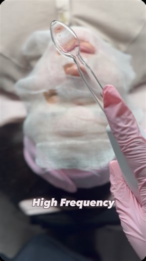 High frequency uses a gentle electrical current to oxygenate the skin, killing acne-causing bacteria and reducing inflammation. The ozone produced during high frequency creates an environment where acne-causing bacteria cannot survive. One of my favorite modalities for acne prone skin﫶 #highfrequencyfacial #highfrequency #facial | MLN Esthetics | Facebook