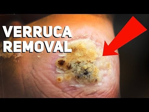 How to Get Rid of Plantar Warts at Home