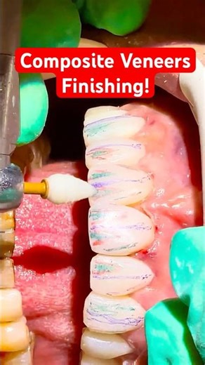 Fast Composite Veneers Finising 