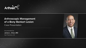 Arthroscopic Management of a Bony Bankart Lesion