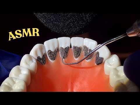[ASMR][Not AI-used] Manual Scaling of Deep Lingual Stains by Real Hygienist