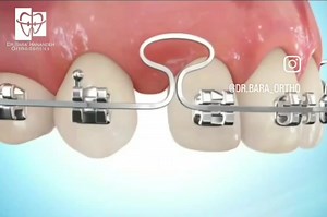 "Closing Loop" :is a method used in #orthodontics to apply forces on teeth and cause them to move in a desired direction. Loop mechanics uses closing loops to generate forces for moving teeth. Unlike sliding mechanics, there is no friction generated between wire and bracket. Therefore, forces are applied directly to the teeth. Different loop designs have been introduced, e.g. here is the "Mushroom Loop" . . . . . #orthodontist#dentistry#style#cool#cute#fun#instagood#photooftheday#fashion#beautif