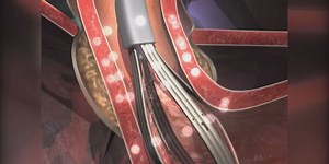 Healthline: Stretta offers relief from GERD