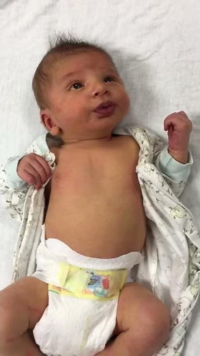 Pyloric Stenosis of 4 week old baby