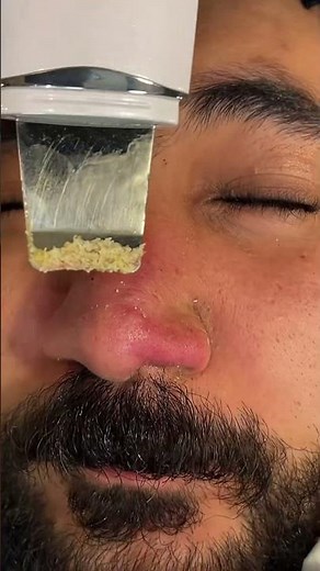 Remove white pimple