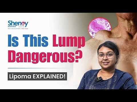 Don’t Ignore This Lump: It Could Be More Than Just Fat! | Lipoma EXPLAINED! | Shenoy Hospitals