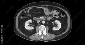 CTA Whole Aorta with Stent-Grafts Coronal view: CTA scan of the whole aorta, highlighting thoracic aorta endovascular stent-grafts placed for aneurysm repair and blood flow restoration.