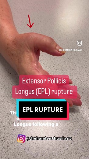 Understanding EPL Rupture: Causes, Symptoms, and Treatments