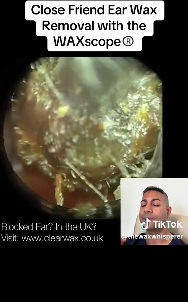 Safe Ear Wax Removal Techniques Using WAXscope®️
