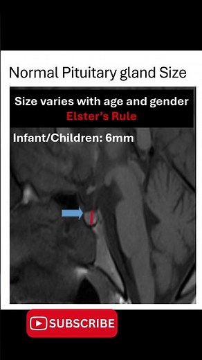 Normal Pituitary Gland Measurements Explained in 30 Seconds