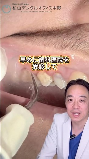 歯石除去の徹底解説!!#松山デンタルオフィス中野 #dentist #歯医者 #歯周病 #歯石