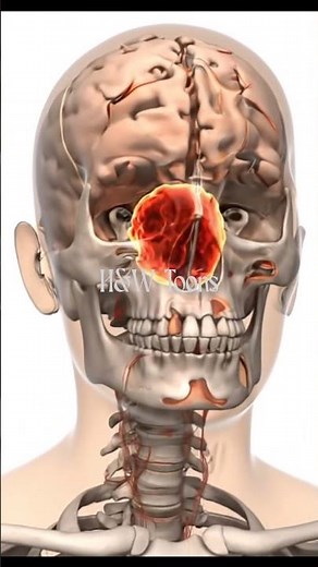 Gigantism #3DMedicalAnimation #Gigantism #Endocrinology #Neurosurgery #GrowthHormone