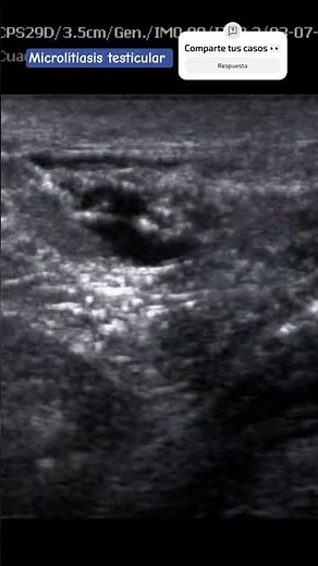 Testicular microlithiasis ultrasound. #testicular #ultrasound #ultrasound #urology