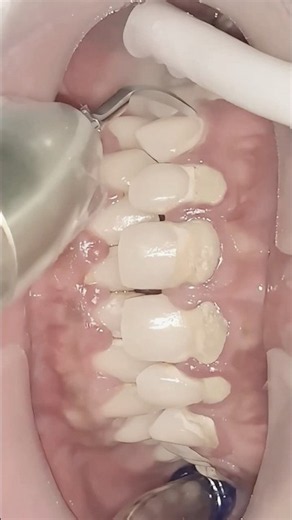 Extreme Tartar Removal ASMR | Most Satisfying Dental Cleaning 🦷