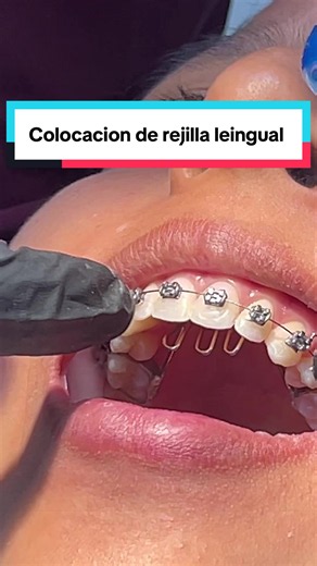 La rejilla lingual un aparato fijo auxiliar para la corrección de hábitos como el chupar dedo (coloquialmente) o para las personas que suelen hablar empujando los dientes , nos ayuda a complementar el trabajo de la ortodoncia #rejillalingual #correciondehabitolingual #ortodoncia