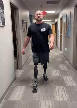 Bilateral Above Knee Amputee Walking Without Cane | Advanced Prosthetic Legs Training