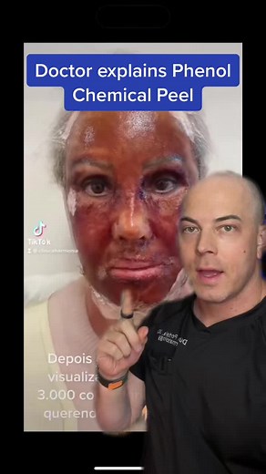 Amazing Phenol Chemical Peel Transformation: Before and After