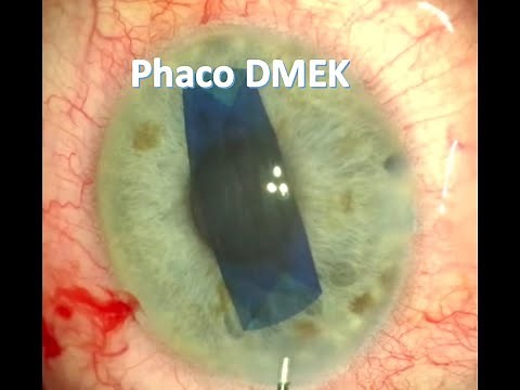 Combined cataract surgery & DMEK corneal transplant in Fuchs' endothelial dystrophy